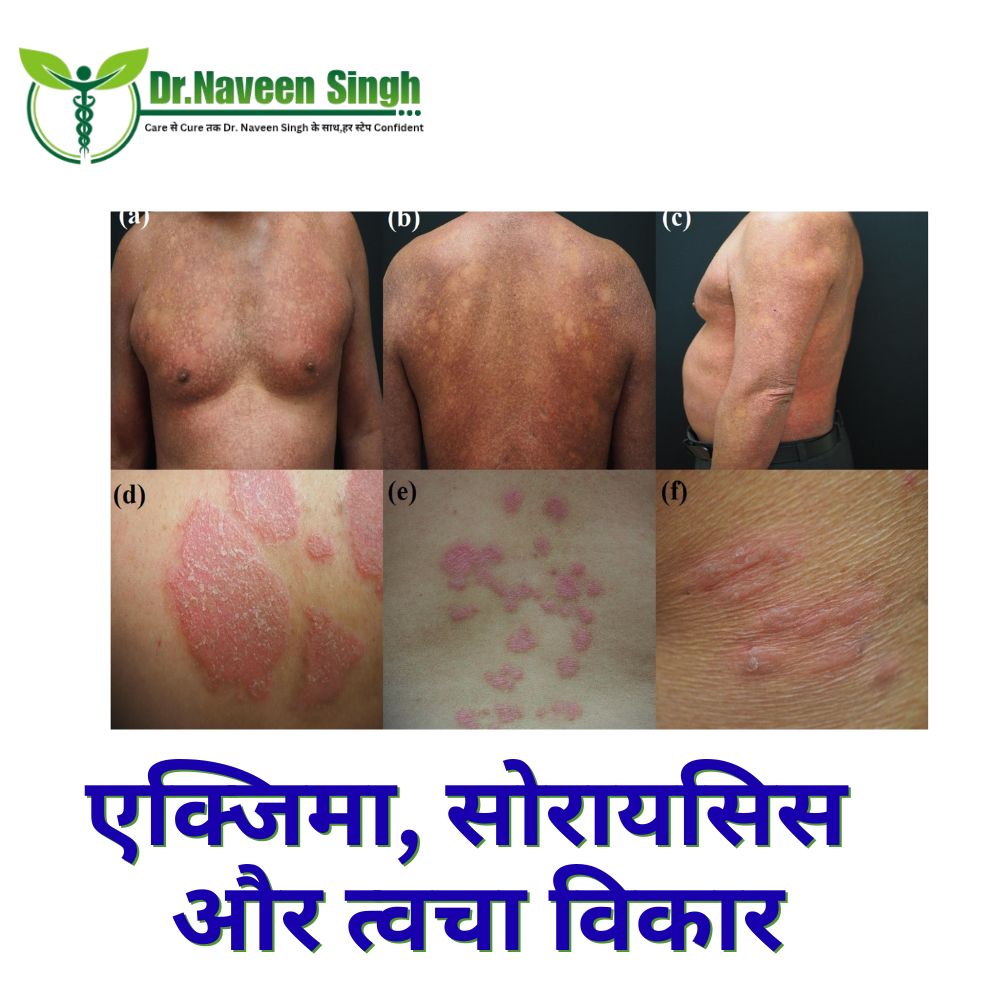 एक्जिमा, सोरायसिस और त्वचा विकार